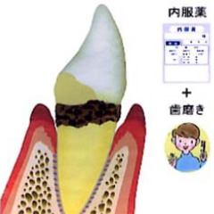 内科的歯周病治療